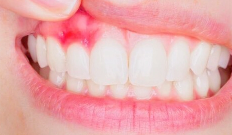 牙齦發炎止痛藥