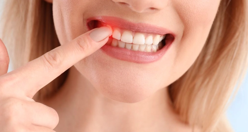 牙齦發炎止痛藥