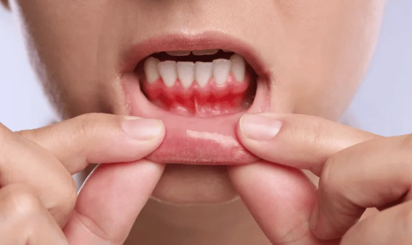 牙齦發炎止痛藥