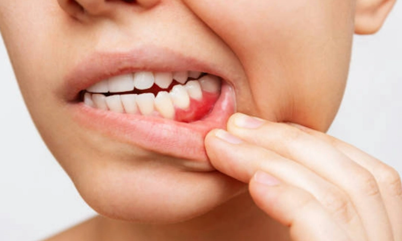 牙齦發炎看哪科