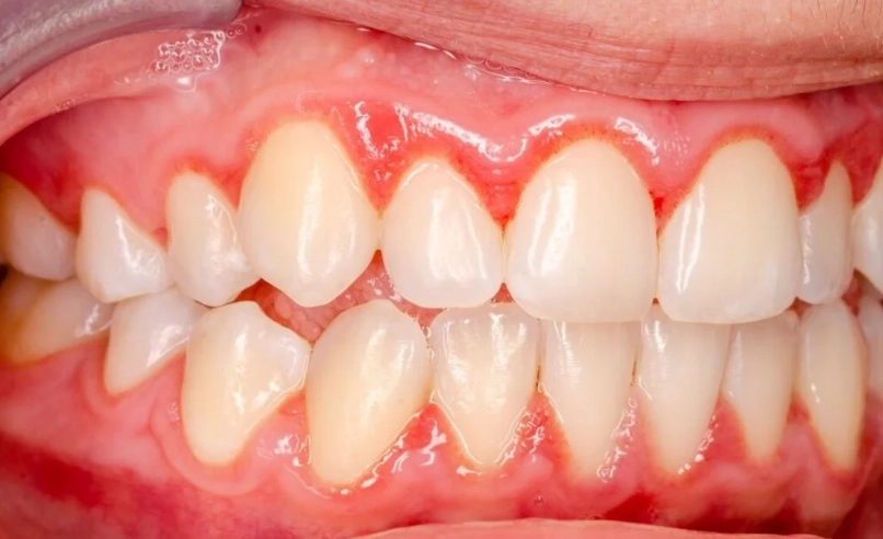 牙齦發炎看哪科