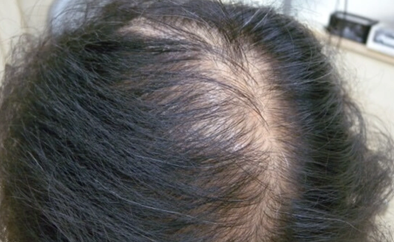 更年期掉髮