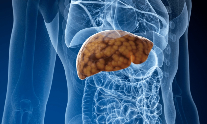 嚴重脂肪肝症狀全解析：隱形警訊與逆轉實戰指南