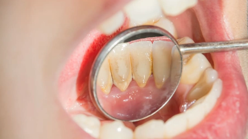 牙菌斑清除 牙菌斑清除