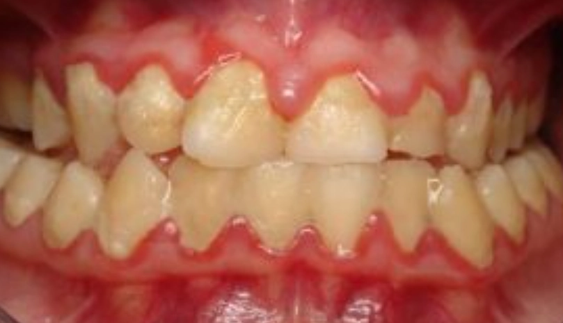 牙菌斑刷不掉原因 牙菌斑刷不掉原因