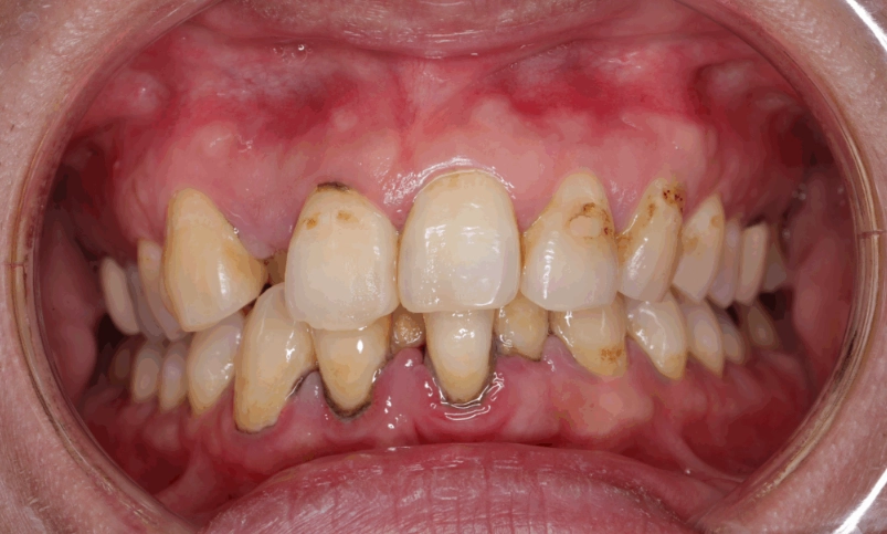 牙菌斑預防方法 牙菌斑預防方法