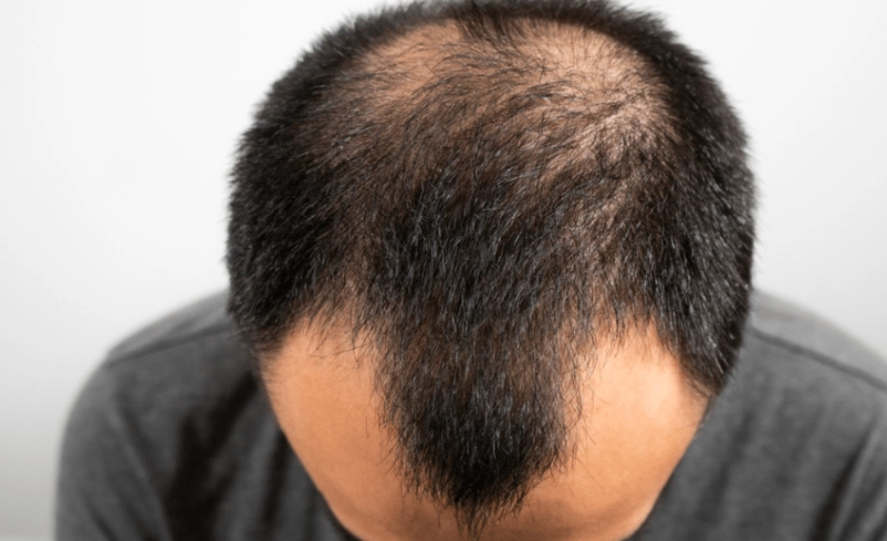 落髮年齡 落髮年齡