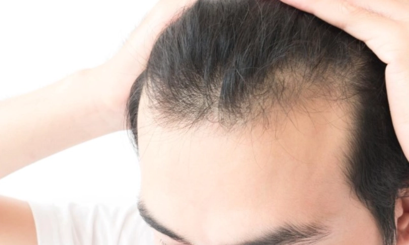 落髮年齡 落髮年齡