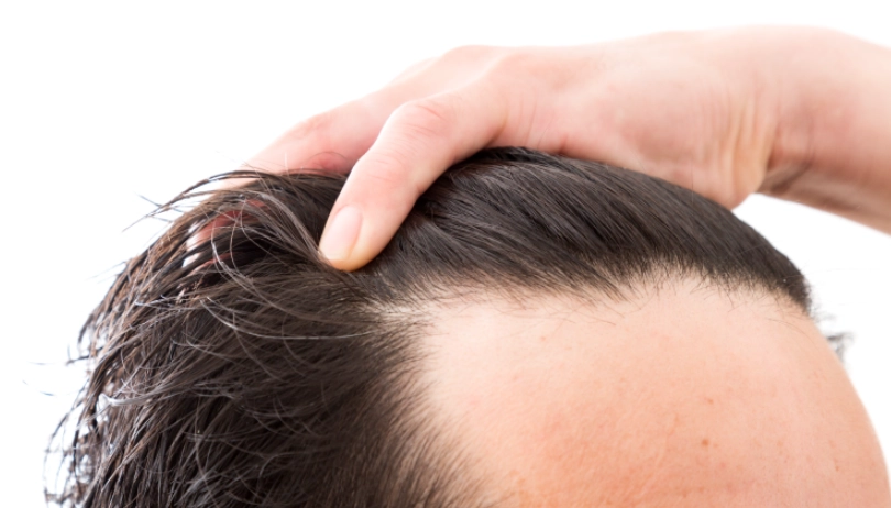 雄性禿年齡 雄性禿年齡