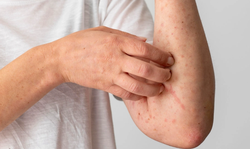 蕁麻疹止癢方法