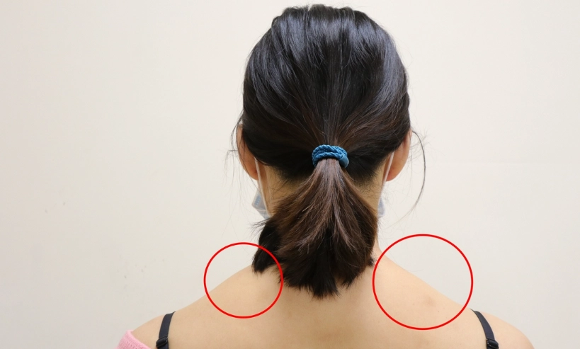 斜方肌發炎症狀