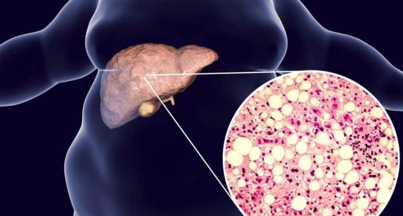 快速改善脂肪肝