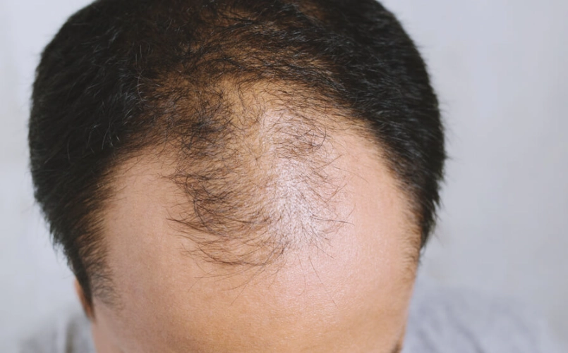 雄性禿治療 雄性禿治療