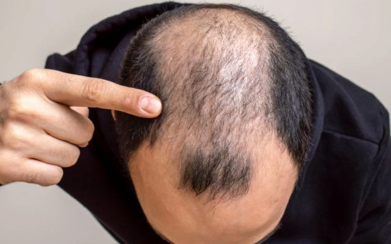 雄性禿治療 雄性禿治療