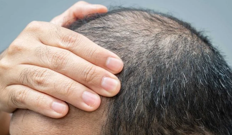 禿頭原因 禿頭原因