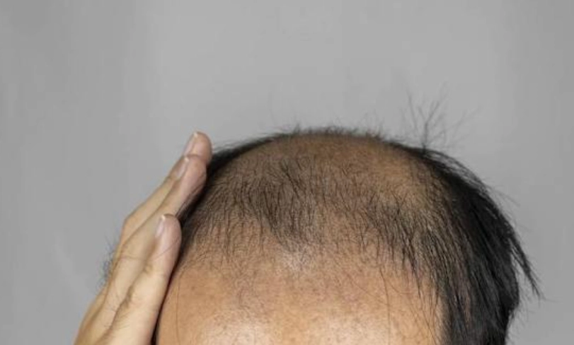 禿頭原因 禿頭原因