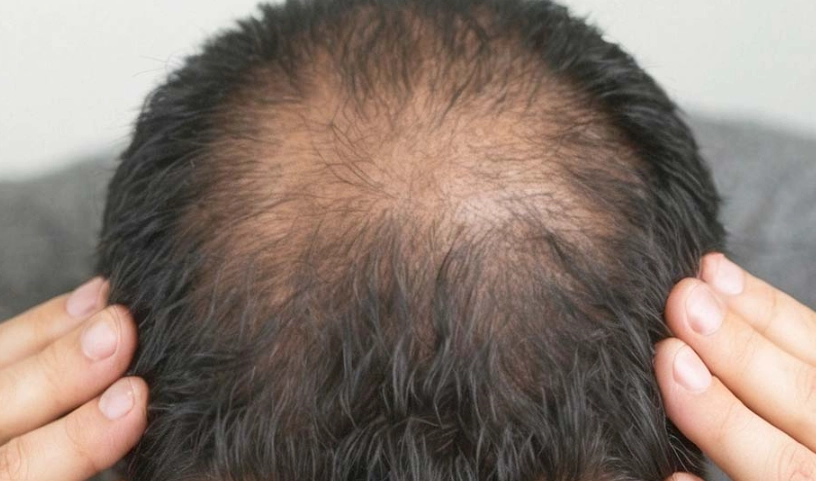 雄性禿治療 雄性禿治療