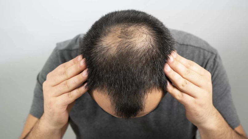 雄性禿早期徵兆 雄性禿早期徵兆
