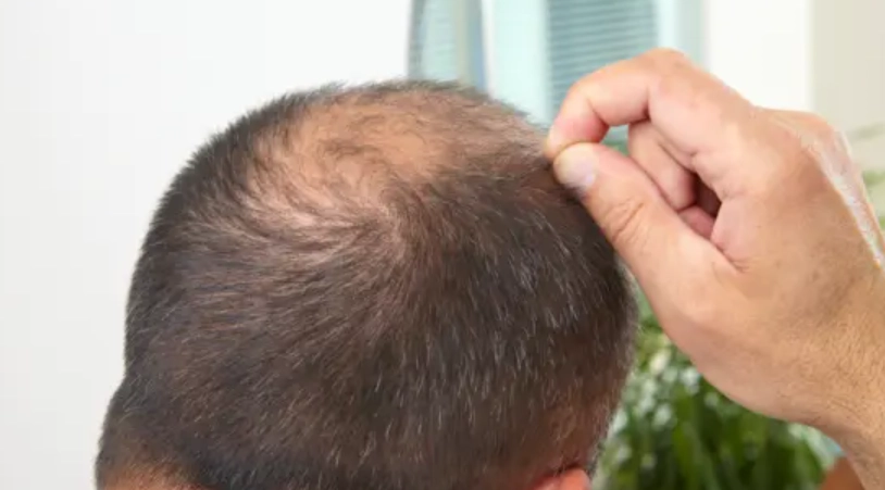 雄性禿遺傳年齡 雄性禿遺傳年齡