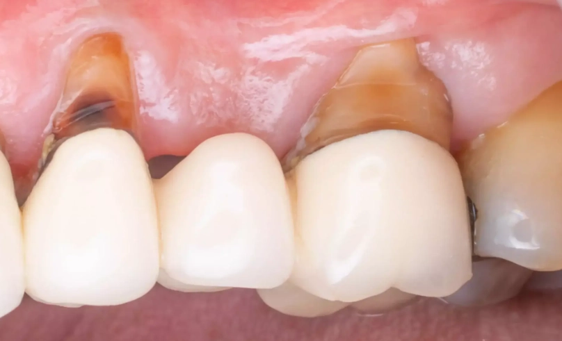 固定假牙牙齦萎縮原因 固定假牙牙齦萎縮原因