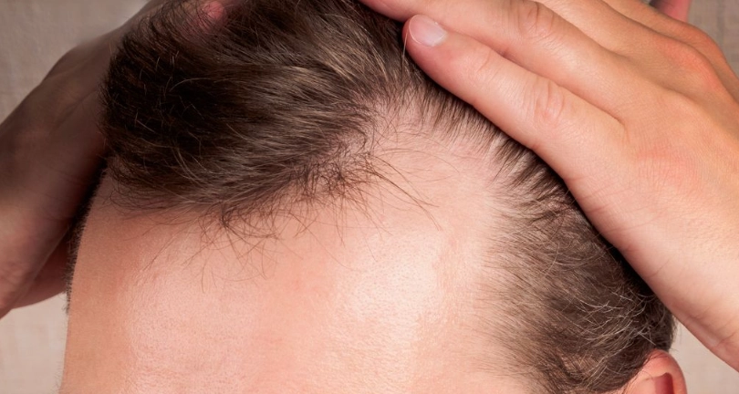 雄性禿遺傳年齡 雄性禿遺傳年齡