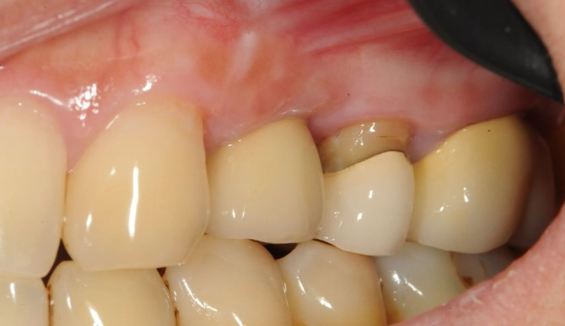 牙橋牙齦萎縮