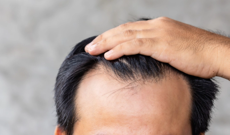 雄性禿早期徵兆 雄性禿早期徵兆