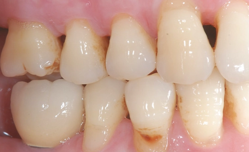 固定假牙牙齦萎縮原因 固定假牙牙齦萎縮原因