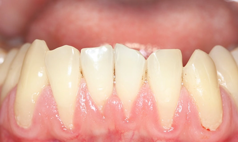 固定假牙牙齦萎縮補救 固定假牙牙齦萎縮補救