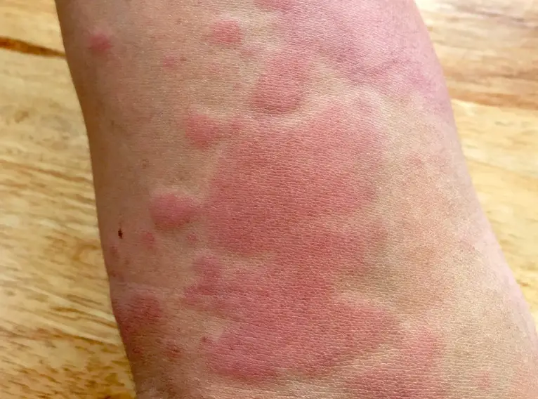 慢性蕁麻疹治療 慢性蕁麻疹治療