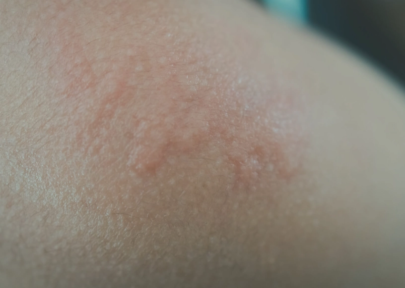 蕁麻疹止癢方法 蕁麻疹止癢方法