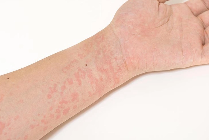 慢性蕁麻疹治療 慢性蕁麻疹治療