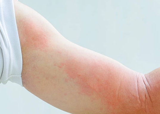 慢性蕁麻疹治療 慢性蕁麻疹治療