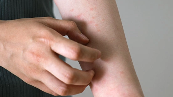 蕁麻疹止癢方法 蕁麻疹止癢方法
