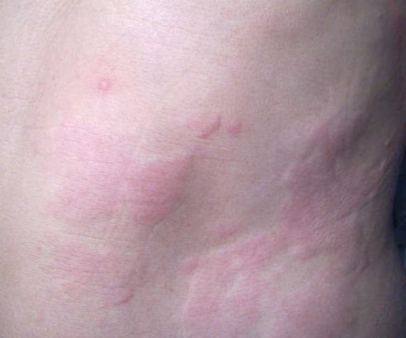 蕁麻疹止癢方法 蕁麻疹止癢方法