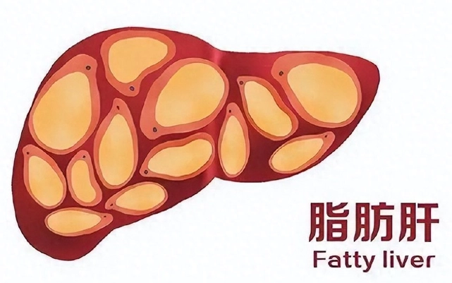 脂肪肝逆轉方法