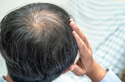 中年掉髮
