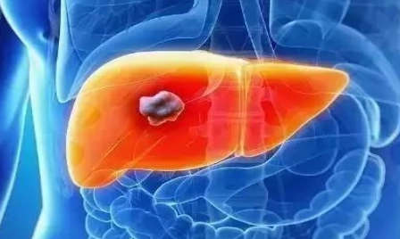 脂肪肝心血管疾病