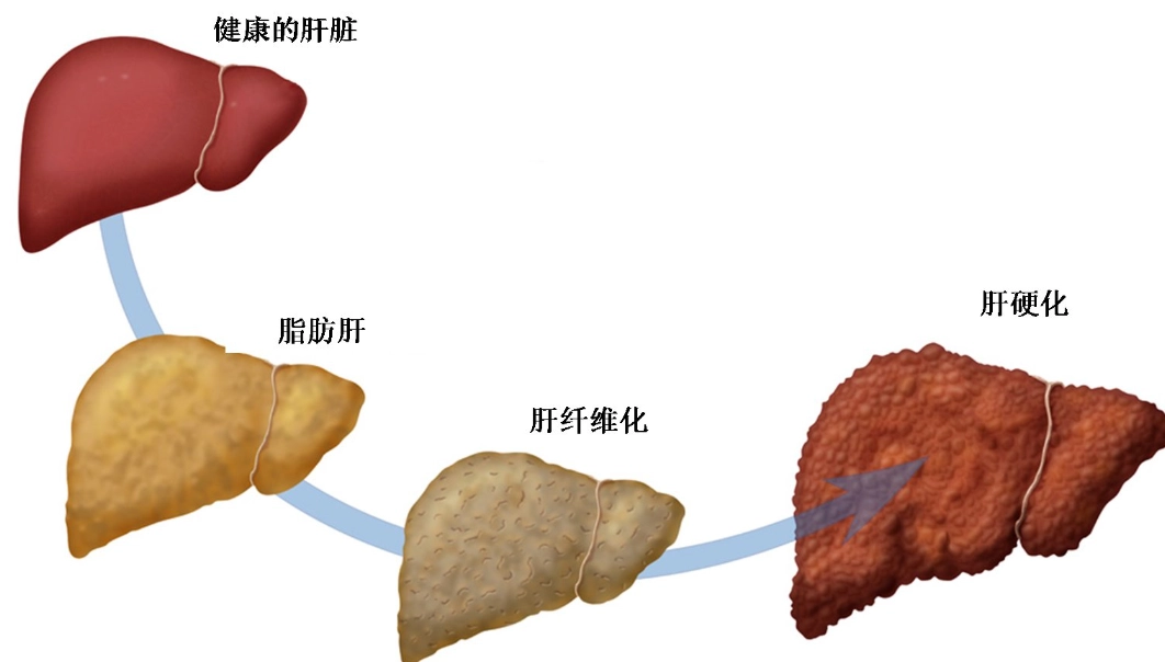 脂肪肝逆轉方法