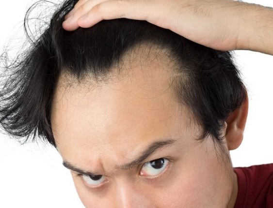 中年掉髮