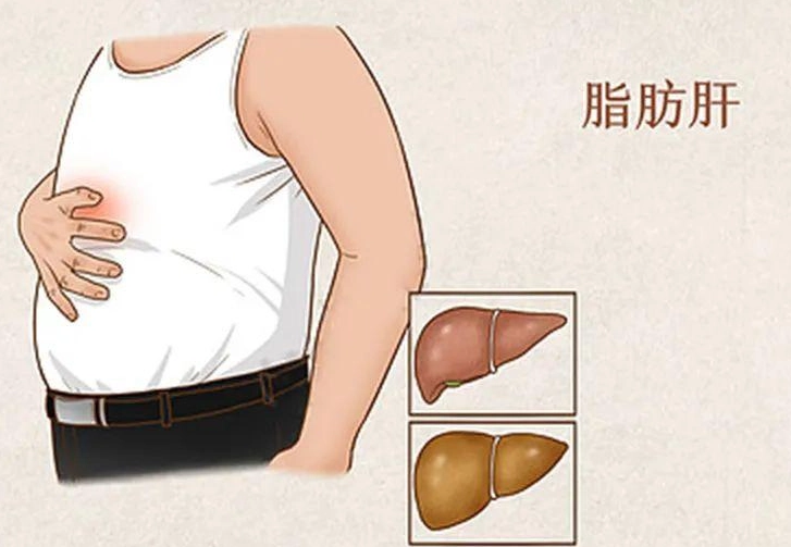 脂肪肝逆轉方法