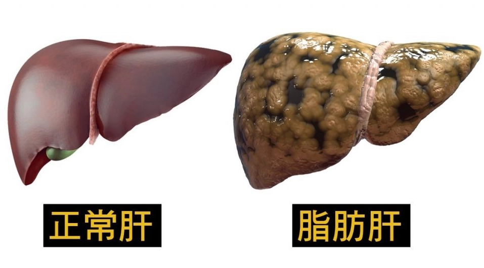 脂肪肝心血管疾病