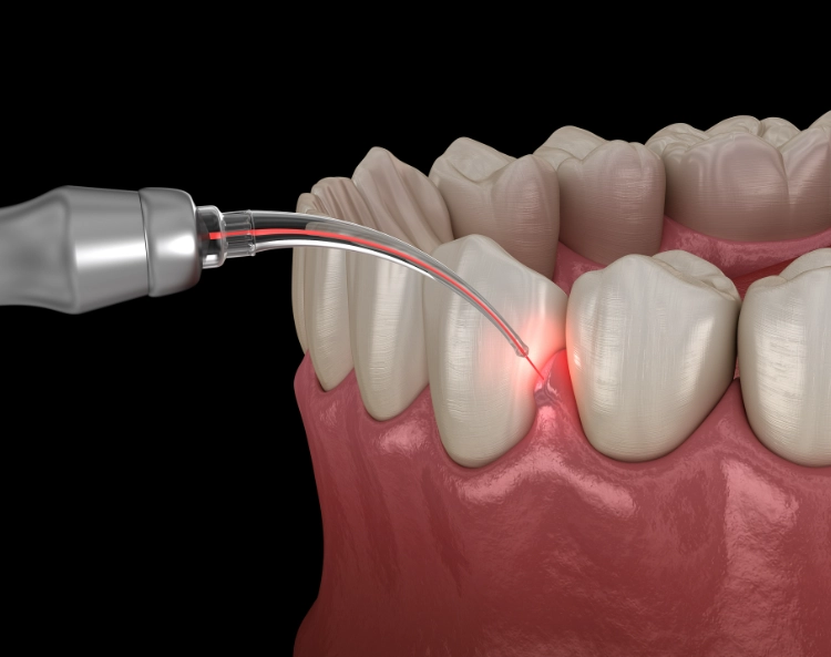 牙周病抗生素藥膏推薦