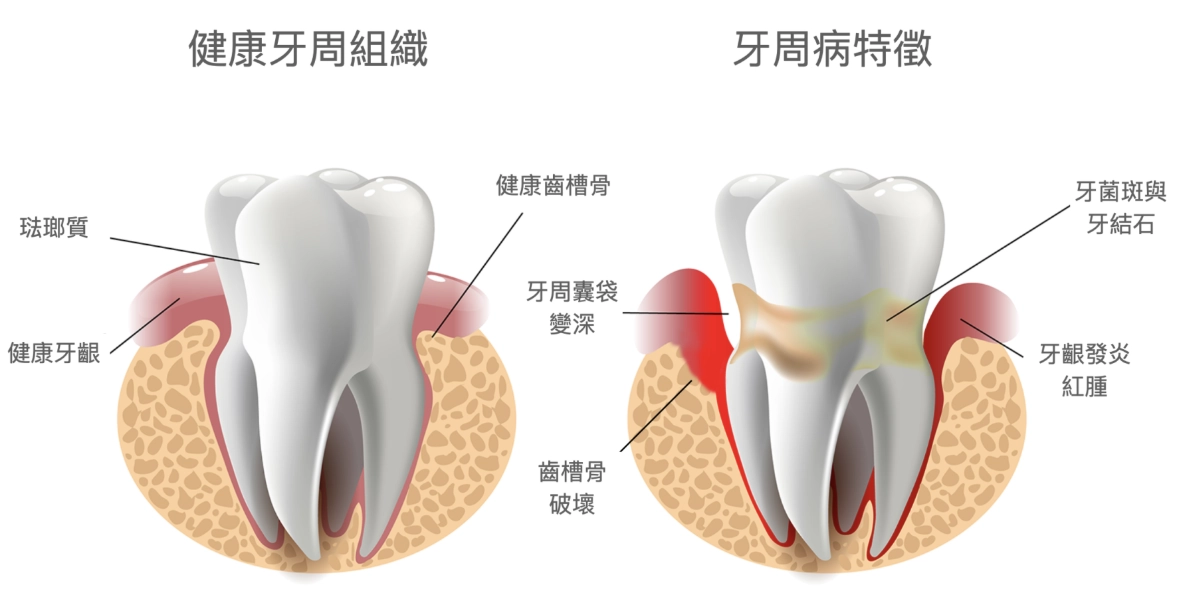 牙周炎怎麼治療最有效