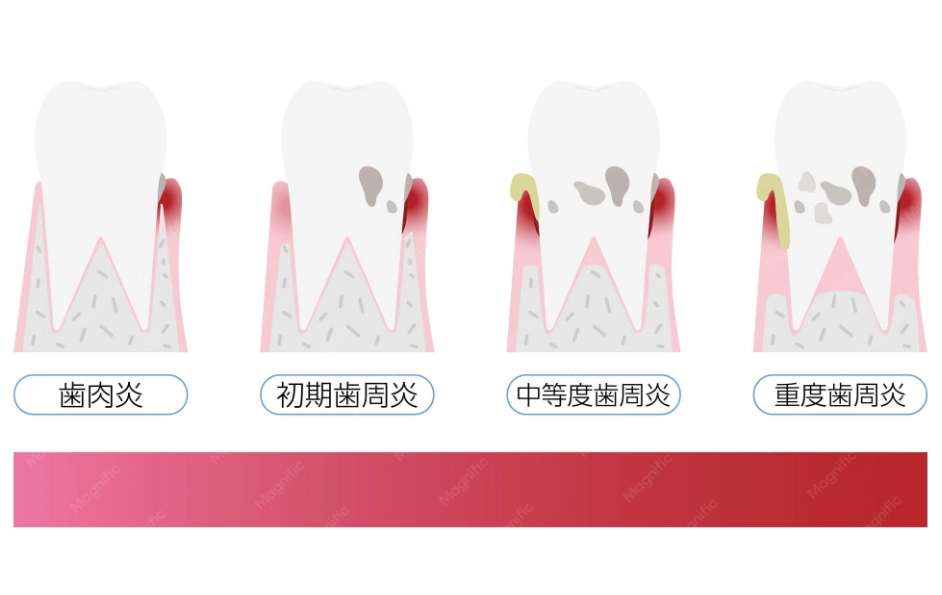 牙周雷射