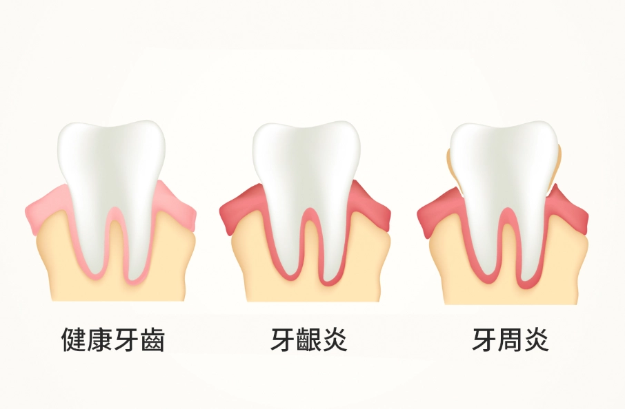 牙周病治療費用