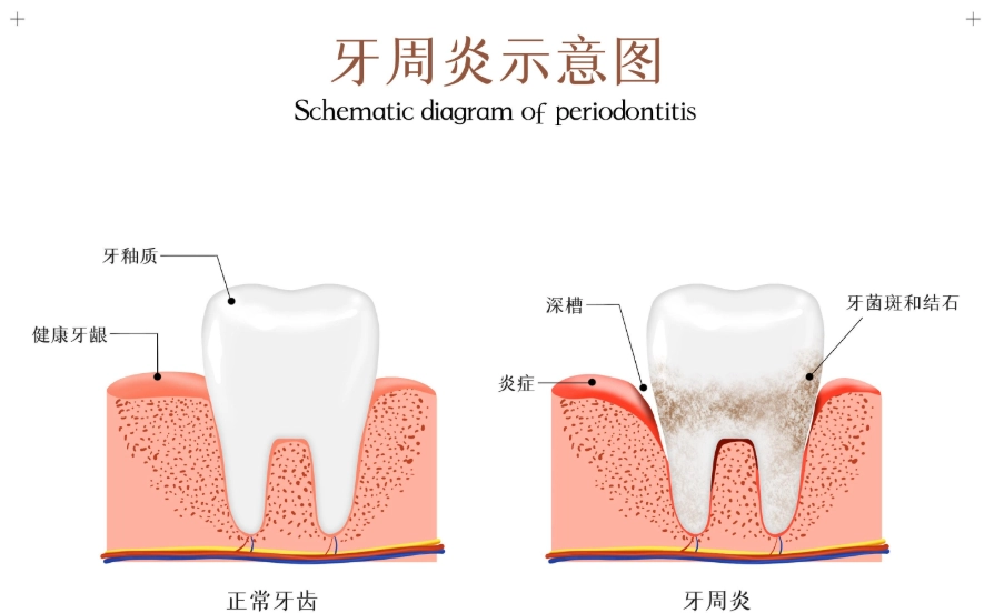 牙周病治療費用