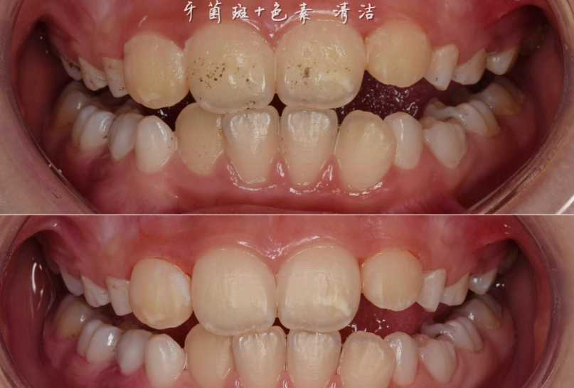 牙菌斑清除方法 牙菌斑清除方法