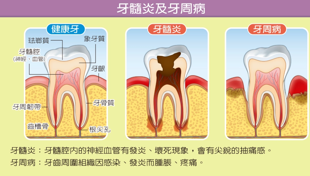 牙菌斑清除方法 牙菌斑清除方法