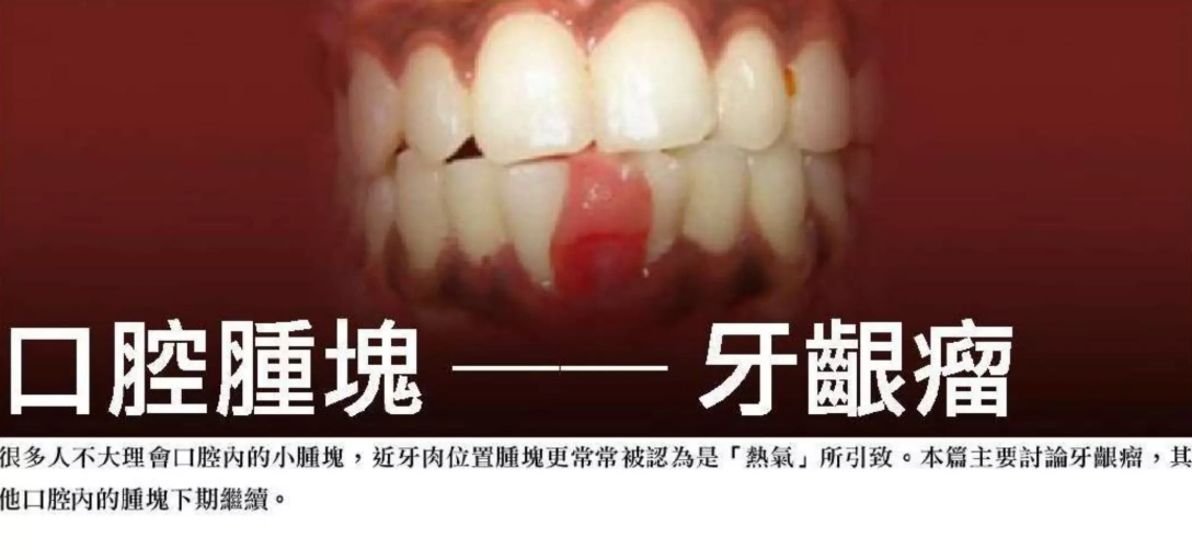 牙齦腫痛怎麼辦
